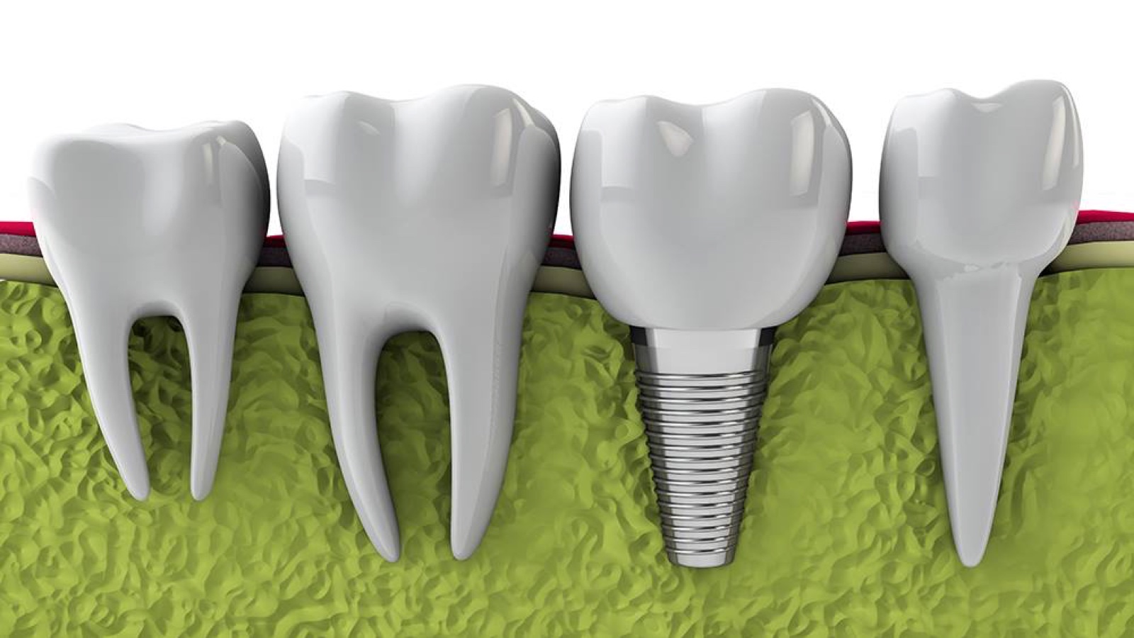 Coroa de porcelana ou com metal: qual a diferença